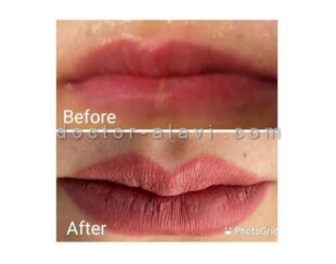 تزریق ژل لب طبیعی رسالت