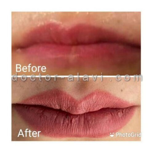 تزریق ژل لب طبیعی رسالت