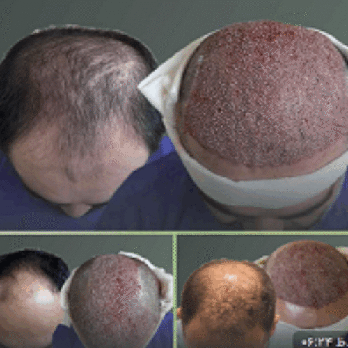 کاشت مو و ابرو با پرداخت 8 تومن و قسطی