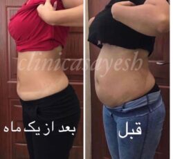 لاغری بدون جراحی با دستگاه کرایولیپولیز