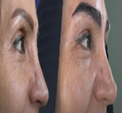 کاشت مو و ابرو با پرداخت 8 تومن و قسطی