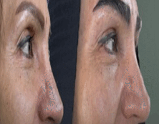کاشت مو و ابرو با پرداخت 8 تومن و قسطی