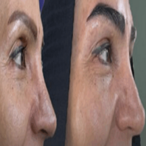 کاشت مو و ابرو با پرداخت 8 تومن و قسطی