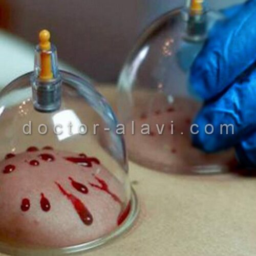 برداشتن خال با لیزر در شرق تهران