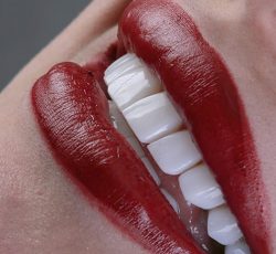 لمینت دندان کرج کامپوزیت اقساط کرج دندانپزشکی ماهانا