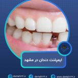 ایمپلنت دندان در مشهد با اقساط بلند مدت، بدون پیش پرداخت ( دیگه نگران هزینه‌ها نباش )