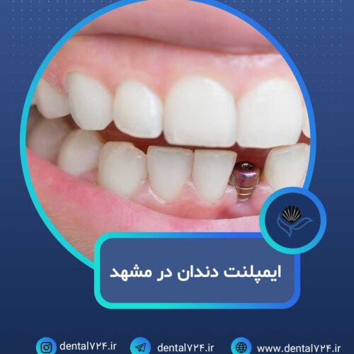 ایمپلنت دندان در مشهد با اقساط بلند مدت، بدون پیش پرداخت ( دیگه نگران هزینهها نباش )