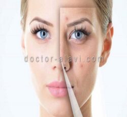پاکسازی و رفع جوش زیرپوستی