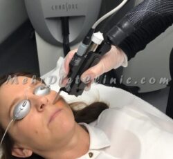 دستگاه لیزر مو های زائد سایناشور آمریکا