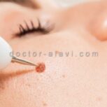 برداشتن خال با لیزر در شرق تهران