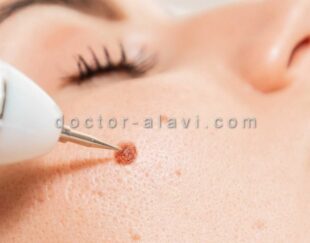 برداشتن خال با لیزر در شرق تهران