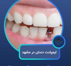 ایمپلنت دندان در مشهدبا اقساط بلندمدت و شرایط ویژه