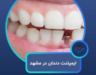 ایمپلنت دندان در مشهدبا اقساط بلندمدت و شرایط ویژه