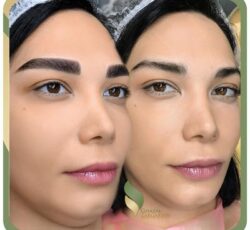 میکروبلیدینگ غزل زرگریان در تهران