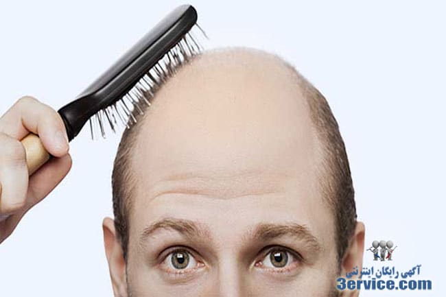 دلایل ریزش مو
